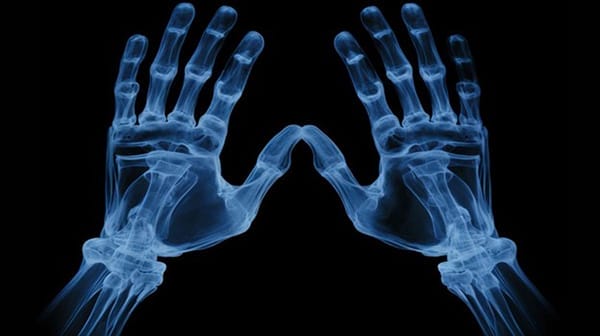 X-ray Skeleton Hands
