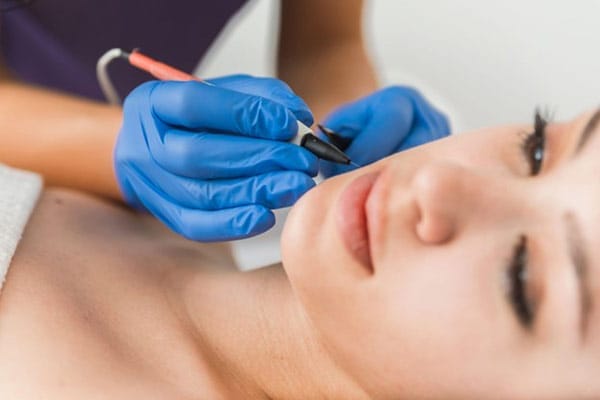 Facial Electrolysis Women Being Operated on